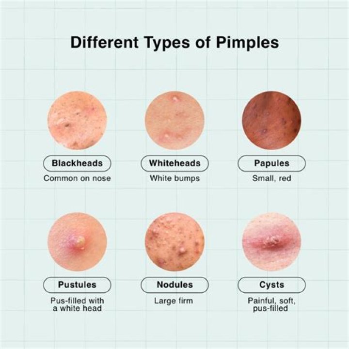 Why is my pimple hard and not popping?