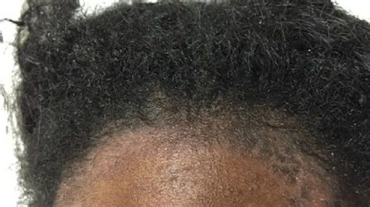 Why is my scalp so itchy African American?