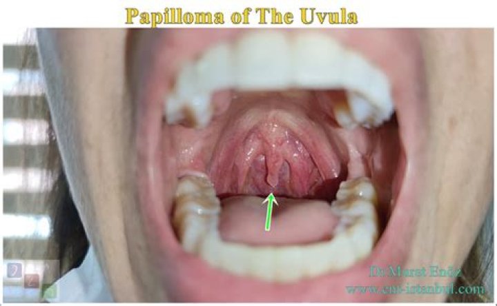 Why is the tip of my uvula white?