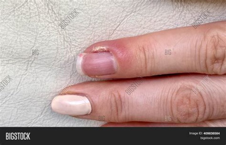 Why one side of the hand has a higher diversity of bacteria?