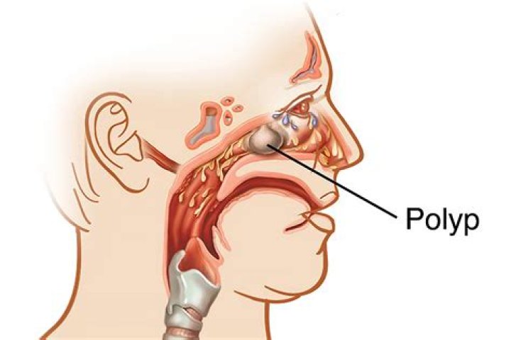 Why would a doctor not remove a polyp?