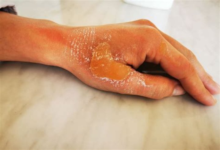 Will a blue laser burn skin?