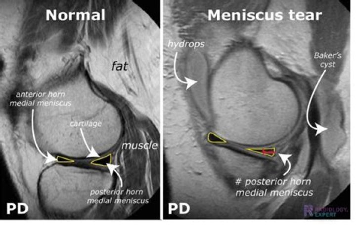 Will an xray show a torn meniscus?