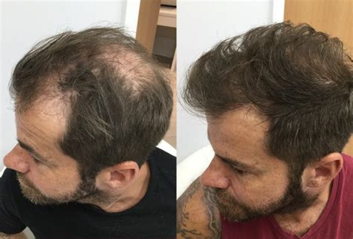 Will hair grow back after Mohs surgery?