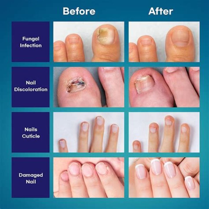 Will Lotrimin work on toenail fungus?