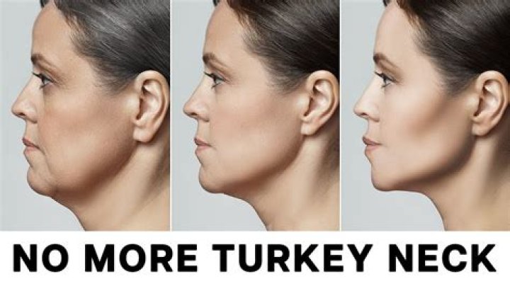 Will microneedling help my turkey neck?