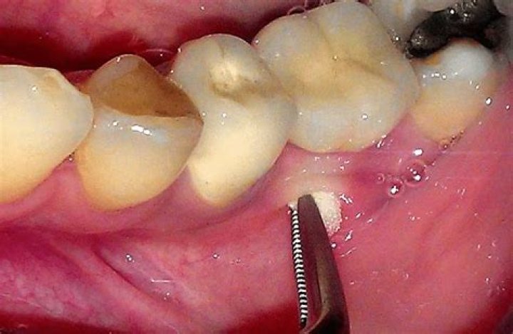 Will the ER pull an abscessed tooth?
